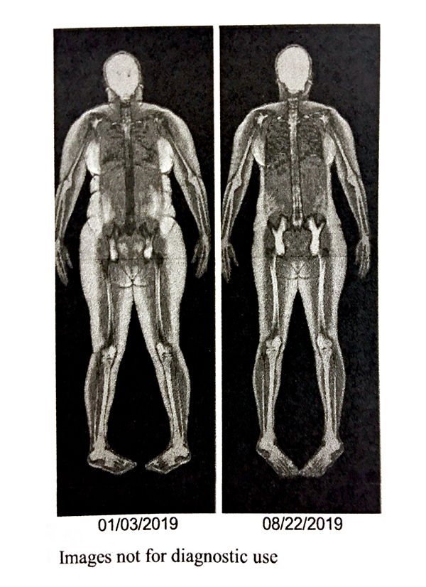 skeletal scan
